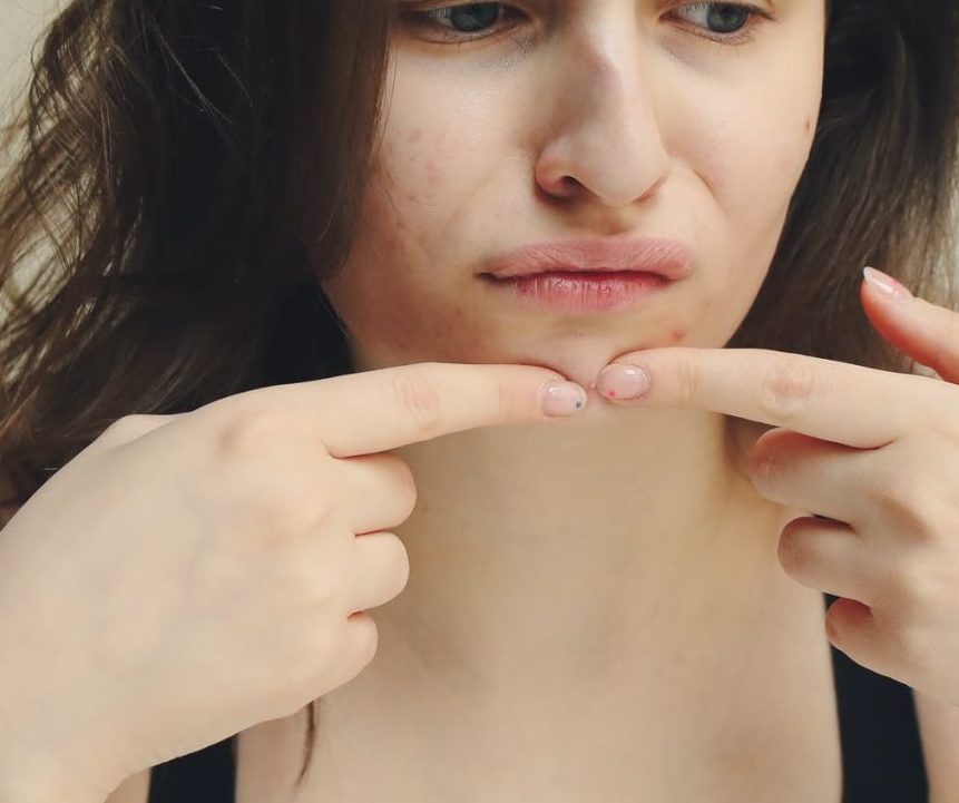 Dealing with Perimenopausal Acne Understanding Causes and Finding Solutions This Is Perimenopause